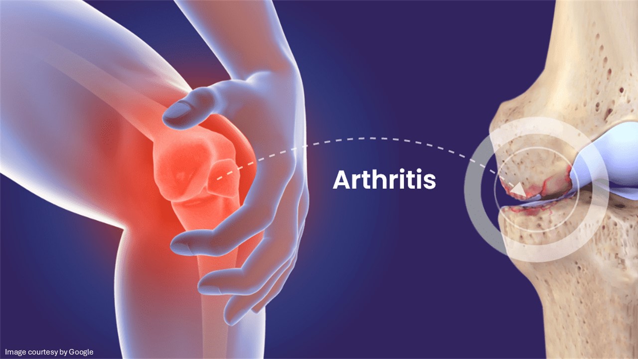 how to prevent arthritis - All Day Chemist