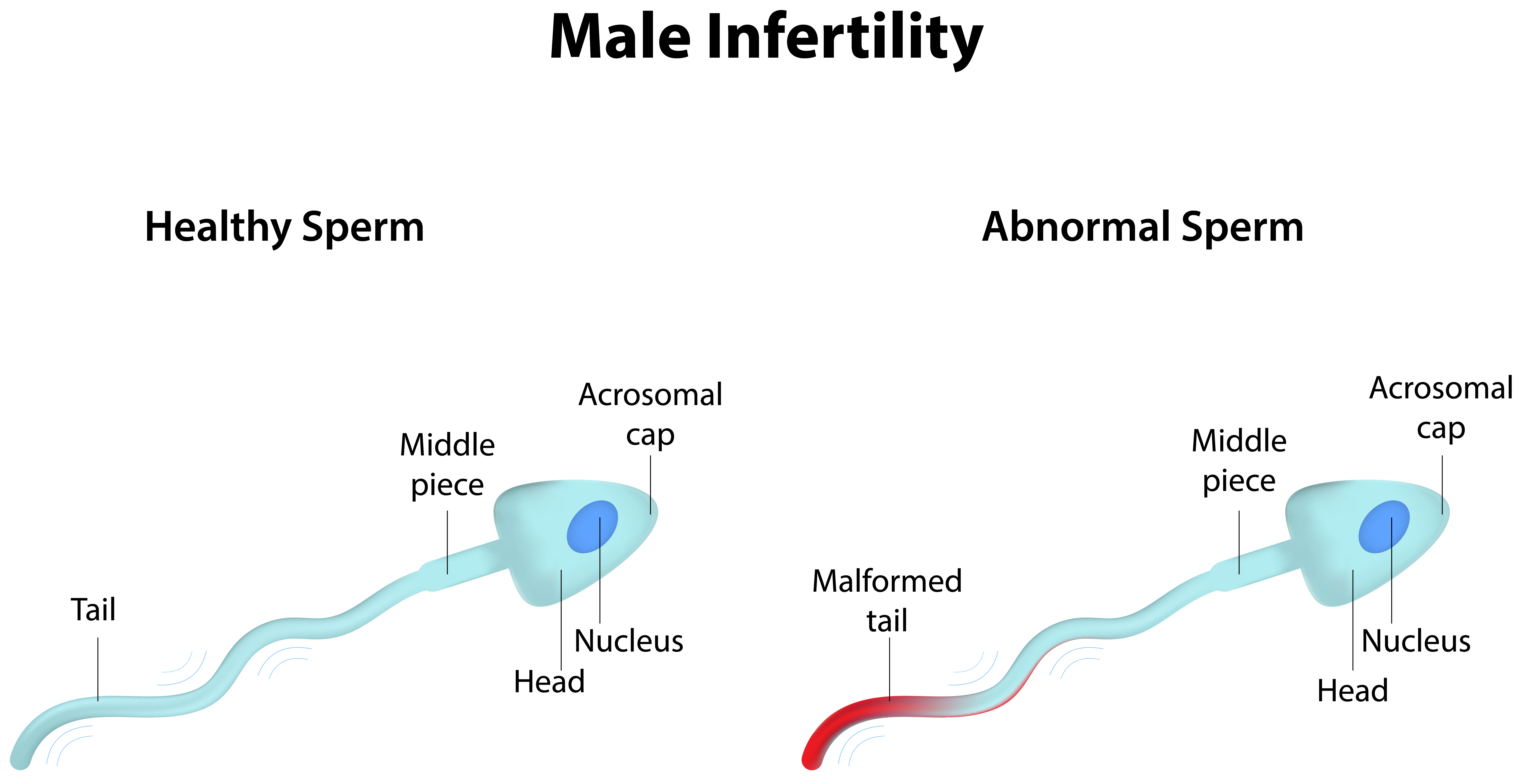 The Growing Problem Of Male Infertility Causes Solutions And Insights