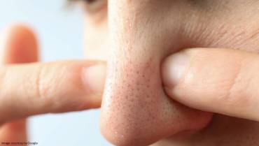 Get rid of blackheads through natural means