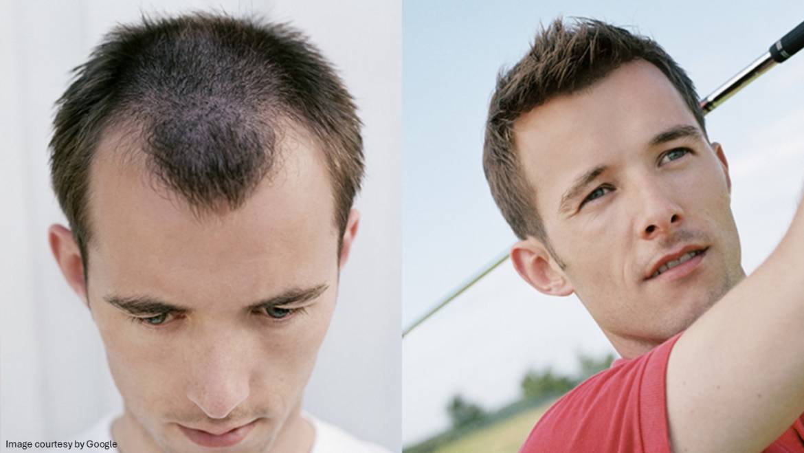 Home remedies for male pattern baldness