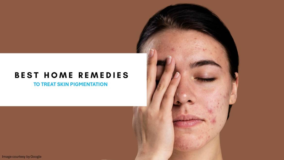 Home remedies to treat skin pigmentation