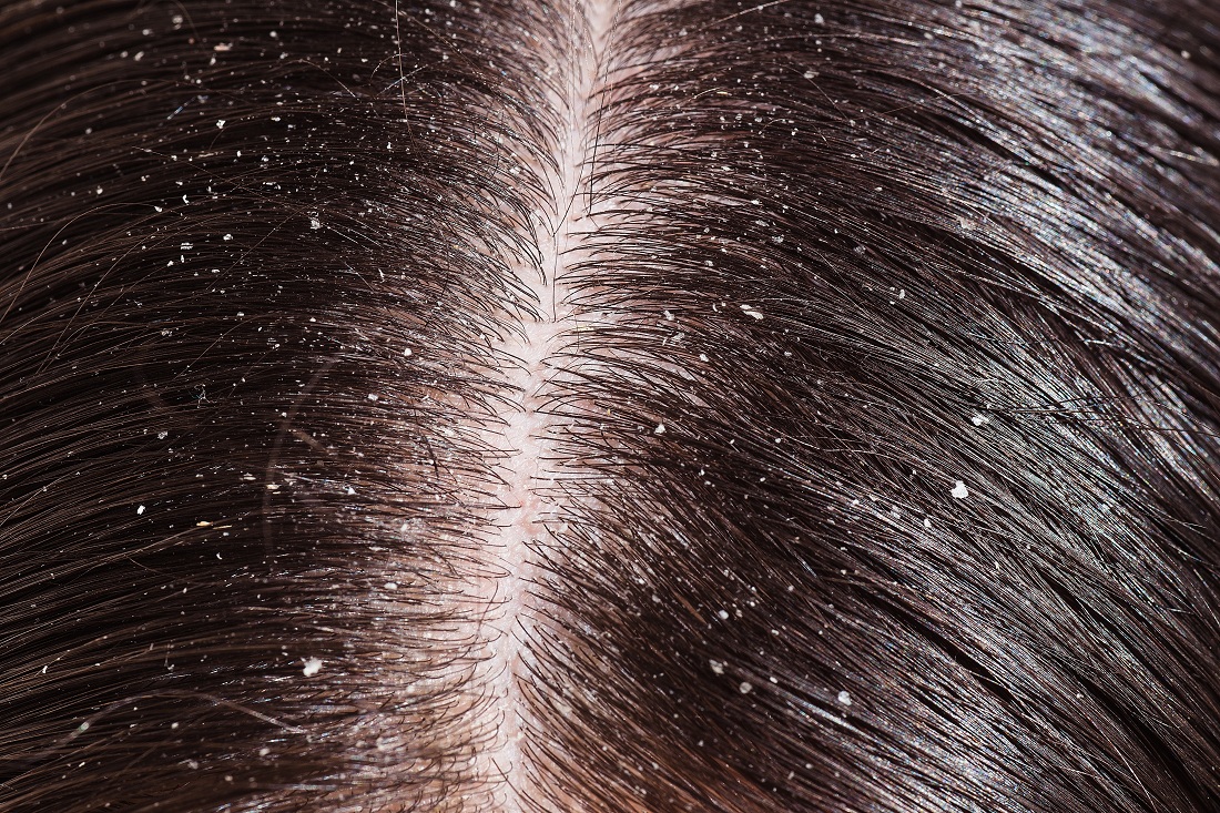 Dandruff And Dry Scalp Are Different But Need Similar Treatment