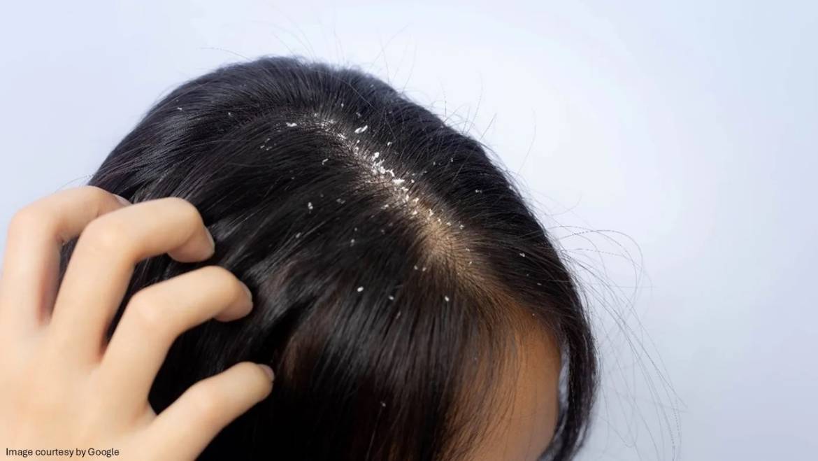 Myths about dandruff