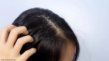 Myths about dandruff