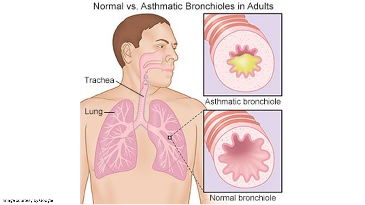 chronic asthma