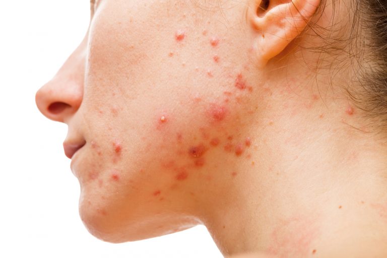 top-5-reasons-why-your-acne-keeps-coming-back