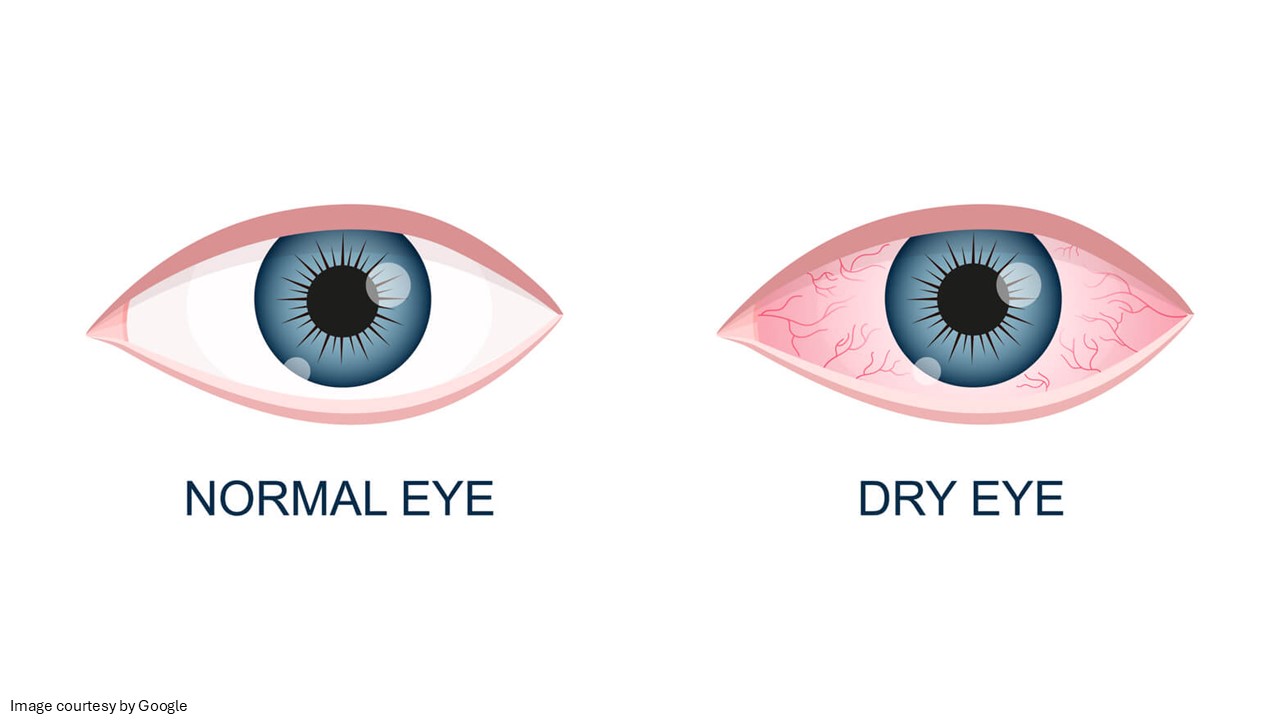 dry eyes treatment - All Day Chemist