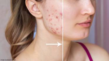 How Supatret Gel Helps To Fight Acne