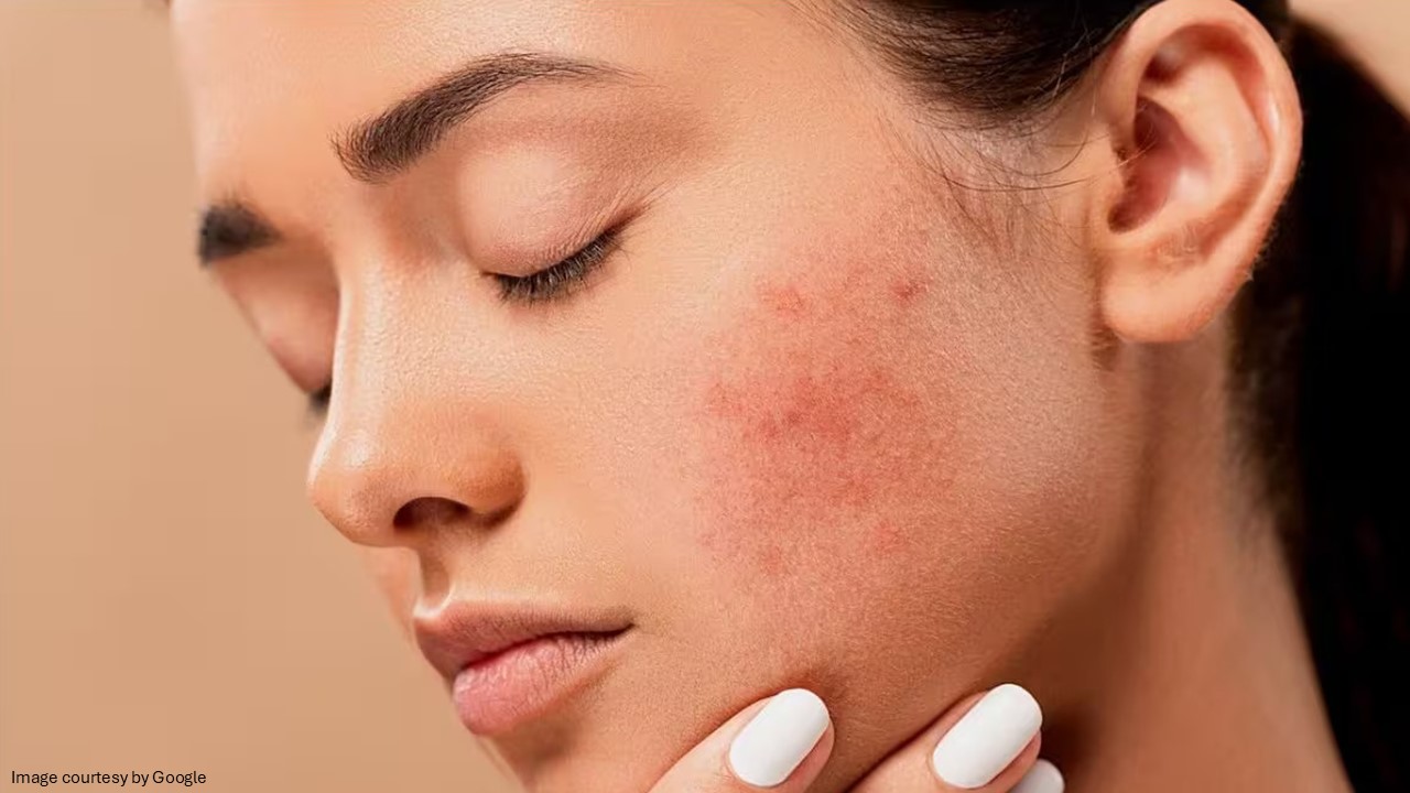 treatment for pimples on face