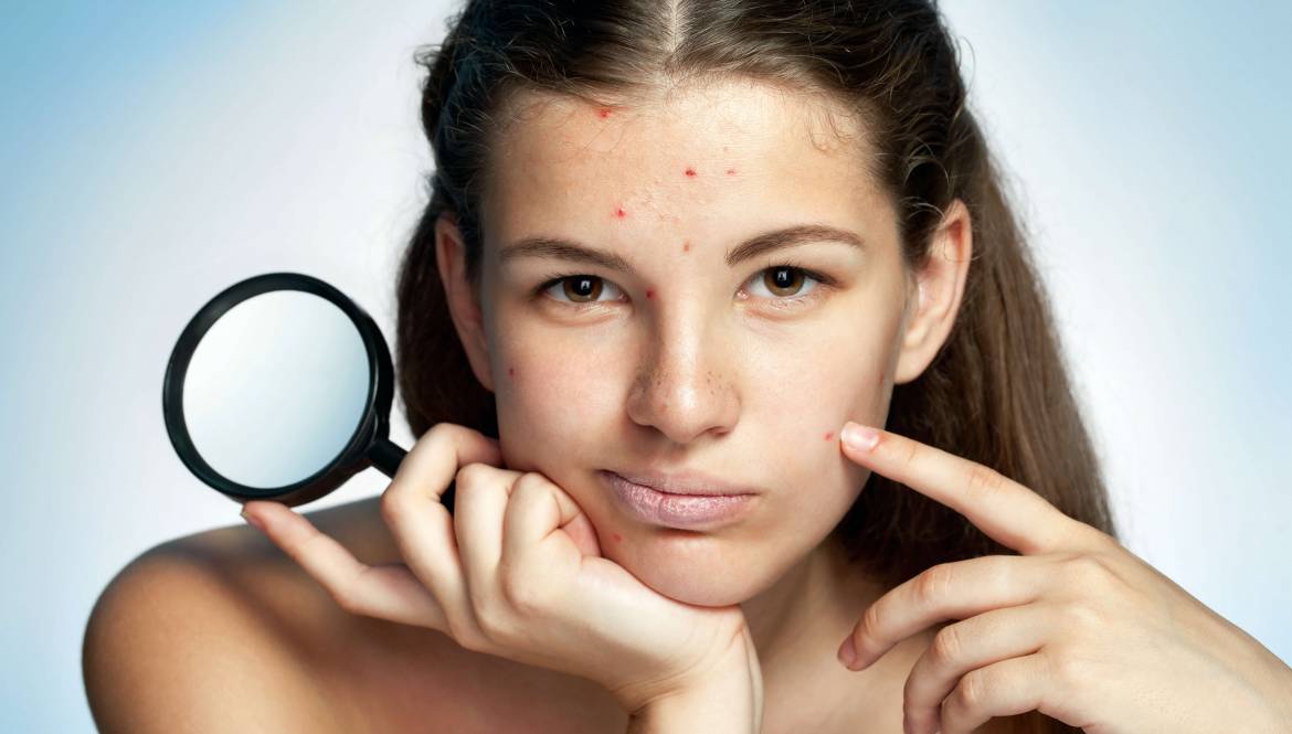 how-to-clear-severe-acne-image-2-alldaychemist-online-pharmacy-blog