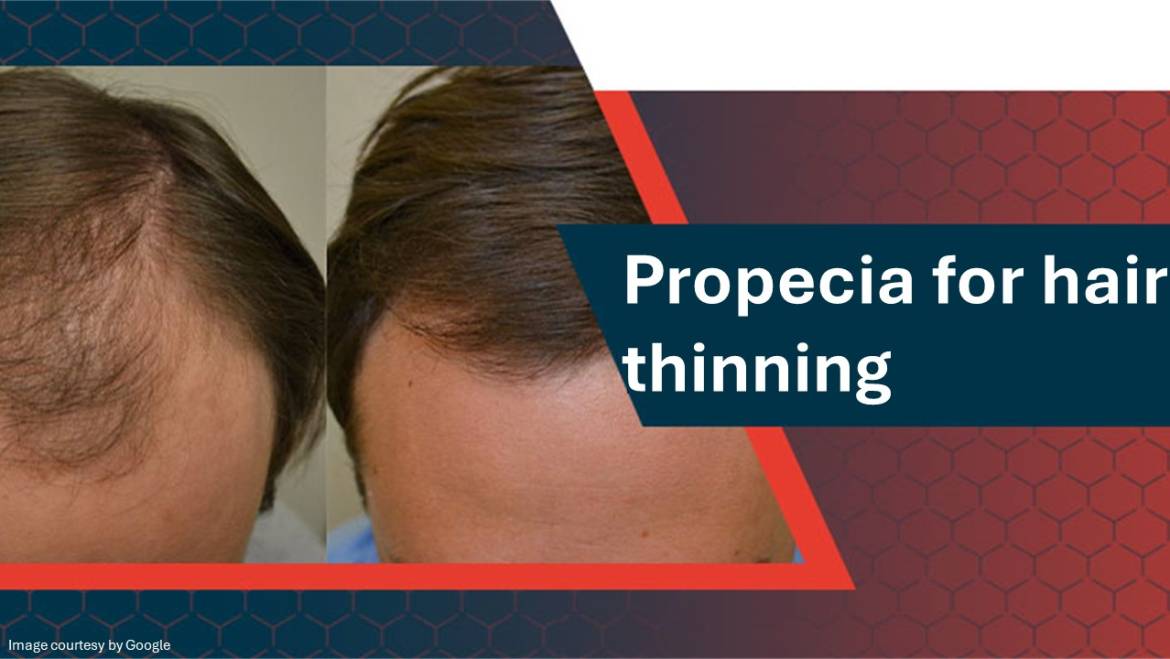 Propecia for Thinning Hair: How Effective is It?