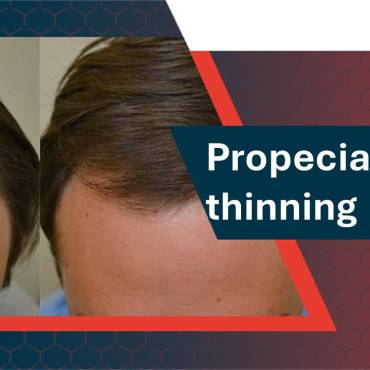 Propecia for Thinning Hair: How Effective is It?