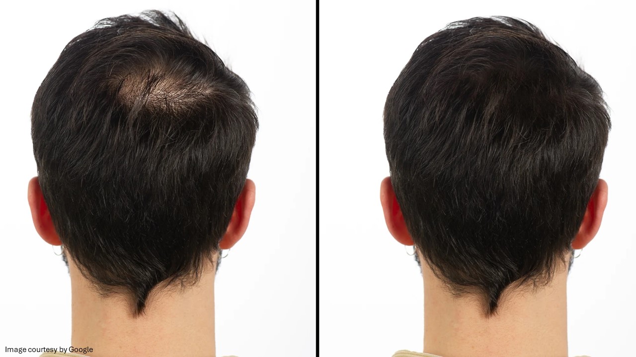 propecia hair loss