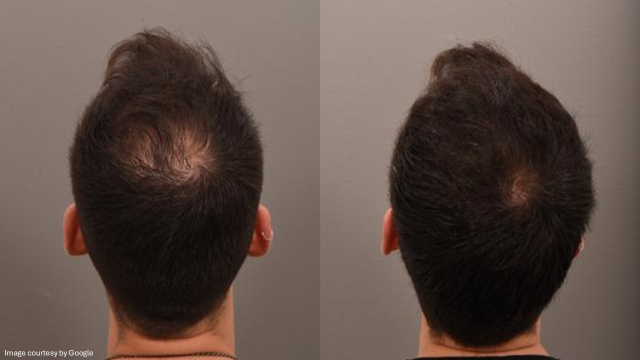 propecia hair loss