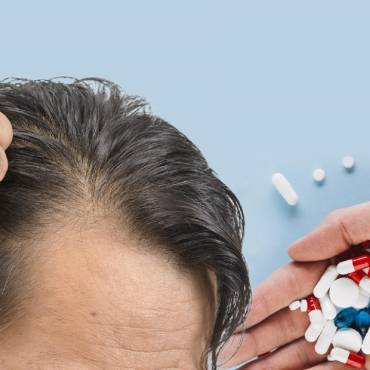 Finasteride for Hair Loss: How It Works and What to Expect